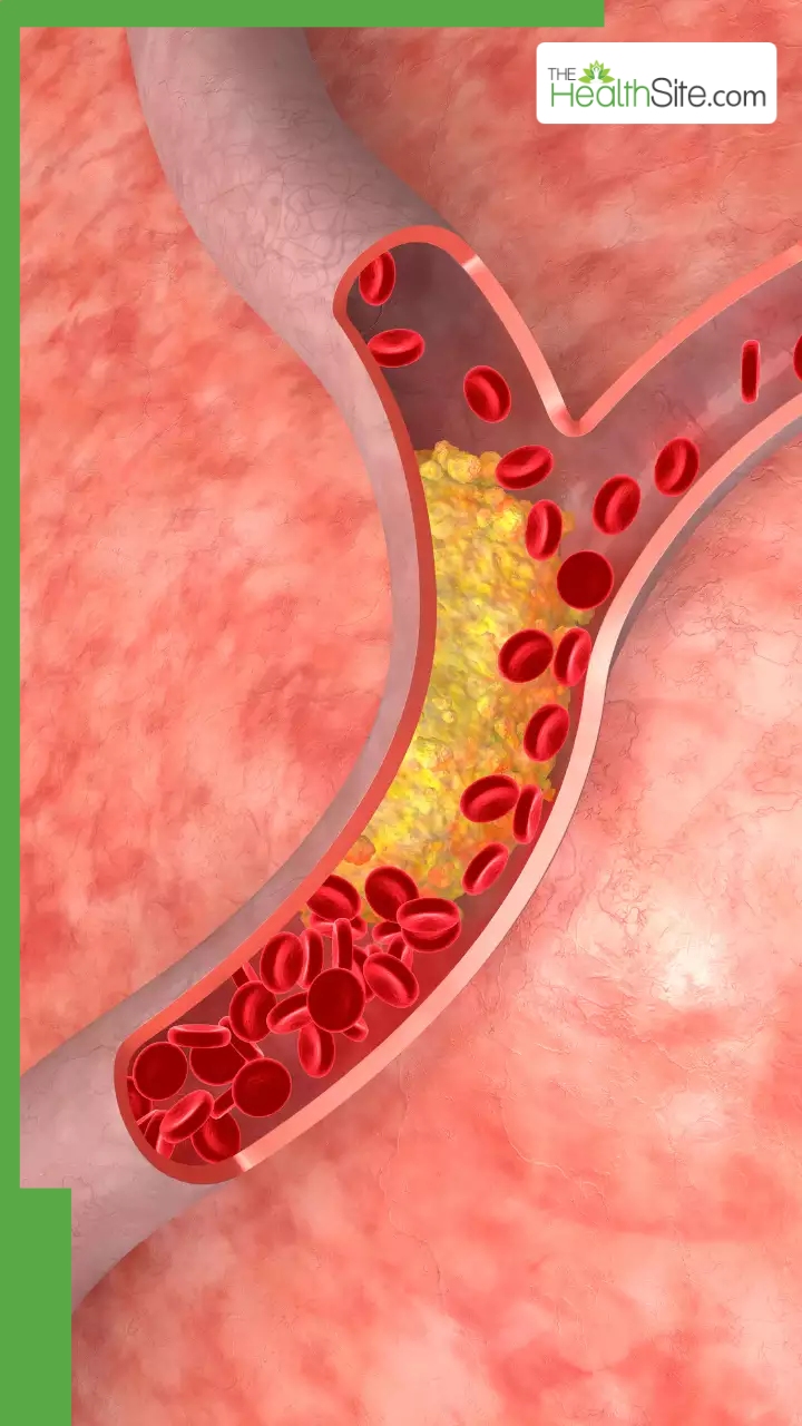 हेल्दी दिखने वाले ये 8 फूड्स भी बढ़ाते हैं शरीर में Bad Cholesterol