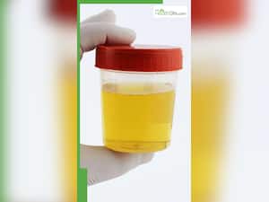 पेशाब में बुलबुले आने का मतलब क्या होता है?