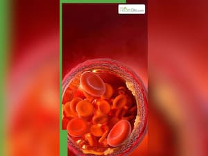 कोलेस्ट्रॉल बढ़ने पर कहां दर्द होता है?