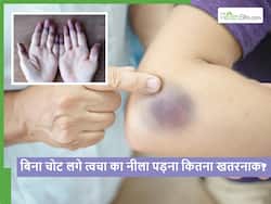Blue Skin: बिना चोट लगे ही पड़ जाते हैं त्वचा पर निशान, तो सावधान हो सकती है ये बड़ी बीमारी