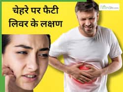 फैटी लिवर होने पर चेहरे पर नजर आते हैं ये 5 लक्षण, होने लगती हैं दाग-धब्बे और रैशेज जैसी समस्याएं