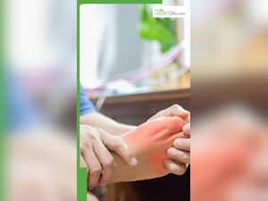 यूरिक एसिड के शुरुआती लक्षण