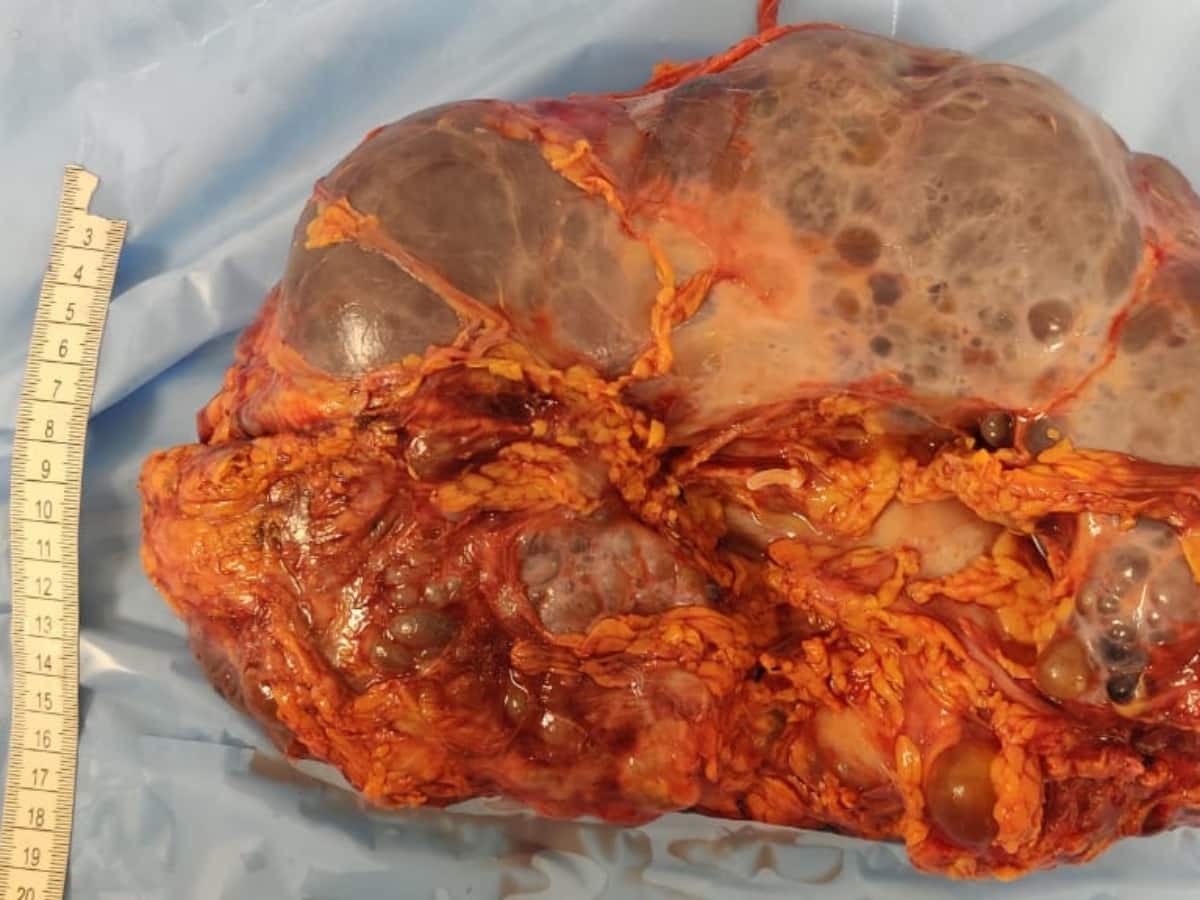 Kidney Disease, Kidney problem, Kidney Pain, Damaged kidney, cysts, case study, medical case, autosomal dominant polycystic kidney disease, kidney disease patient, cysts in the kidney, kidney surgery, nephrectomy procedure
