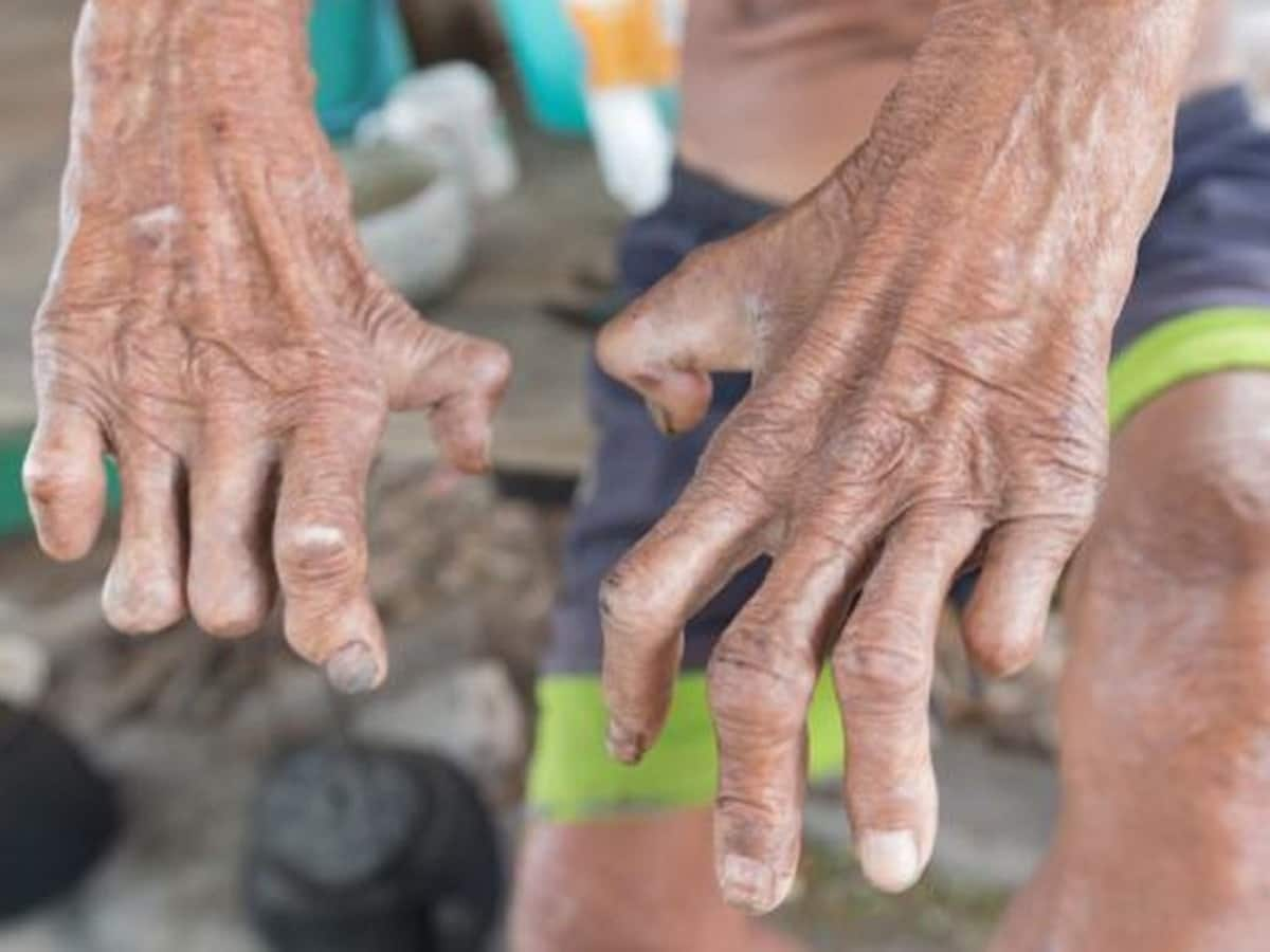 The Connection Between Leprosy And Chronic Pain: A Neurological Insight