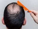 Male Patterned Hair Loss In Early 20s Can Be Reversed: Causes And Solutions For Baldness In Young Men