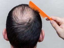 Male Patterned Hair Loss In Early 20s: Causes And Solutions For Baldness In Late Teens, Early Twenties