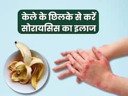 सोरायसिस के इलाज में प्रभावी है केले का छिलका, जानें प्रयोग का तरीका