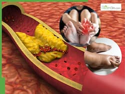 Clogged Arteries Symptoms: 7 Unusual Signs of Heart Blockage That Appear In Legs And Feet