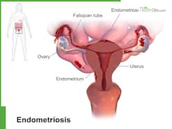 Why Early Diagnosis Of Endometriosis Is Crucial For Women   s Health