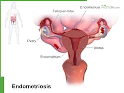 Why Early Diagnosis Of Endometriosis Is Crucial For Women   s Health
