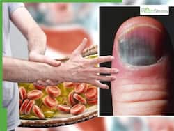 High Cholesterol Symptoms in Men 40s: 7 Warning Signs of High Bad LDL Cholesterol In Fingernails