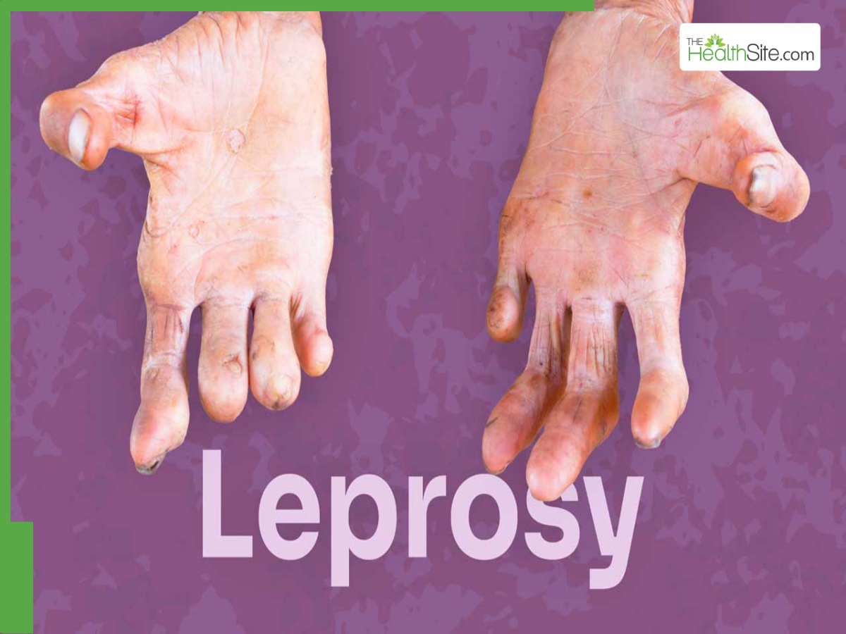 Understanding Leprosy: Symptoms, Transmission, And Treatments Available Today