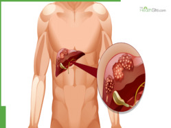 Understanding Liver Cancer: Signs, Prevention, And Latest Treatments