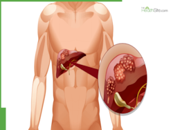 Understanding Liver Cancer: Signs, Prevention, And Latest Treatments