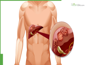 Understanding Liver Cancer: Signs, Prevention, And Latest Treatments