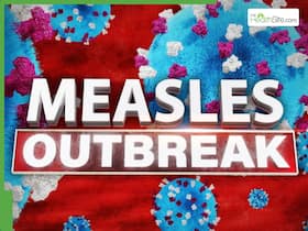 Measles Outbreak Sweeps Through US, Over 130 Infected; Texas Reports First Death Since 2015: What Is Measles? Measles Outbreak Sweeps Through US, Over 130 Infected; Texas Reports First Death Since 2015: What Is Measles?