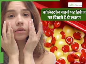 कोलेस्ट्रॉल बढ़ने पर स्किन पर दिखाई देते हैं ये 5 लक्षण, शरीर के ये अंग बदलते हैं रंग
