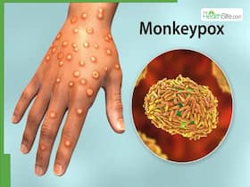 UAE Reports First Case Of Mpox Clade 1b Variant: WHO Report UAE Reports First Case Of Mpox Clade 1b Variant: WHO Report