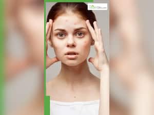पिंपल हटाने वाले 8 घरेलू नुस्खे, 100% होगा असर