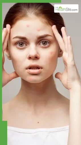 पिंपल हटाने वाले 8 घरेलू नुस्खे, 100% होगा असर पिंपल हटाने वाले 8 घरेलू नुस्खे, 100% होगा असर