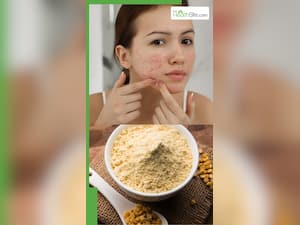मुंहासे मिटाने के लिए बेसन कैसे लगाएं?