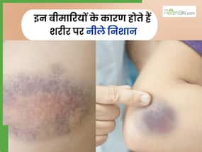 इन 5 गंभीर बीमारियों की वजह से शरीर पर बनने लगते हैं नीले निशान, खून में दिखता है इसका पहला लक्षण