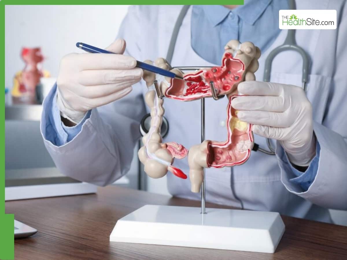 कोलोरेक्टल कैंसर के शुरुआती लक्षण: पेट दर्द, कब्ज और मल में खून पर ध्यान दें