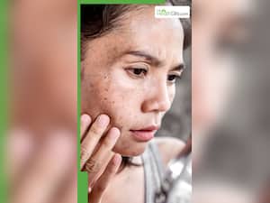 चेहरे के दाग-धब्बे मिटाने के लिए क्या लगाएं?