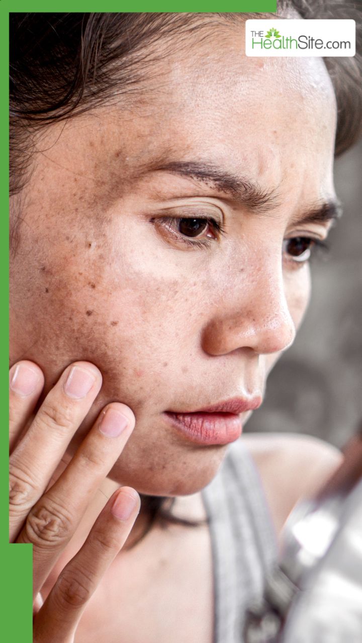 चेहरे के दाग-धब्बे मिटाने के लिए क्या लगाएं?