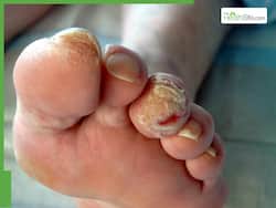 Case Study: How A 50-Yr-Old Diabetic Cop Was Saved From A Flesh-Eating Bacterial Infection