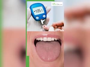 डायबिटीज में बार-बार मुंह क्यों सूखता है?