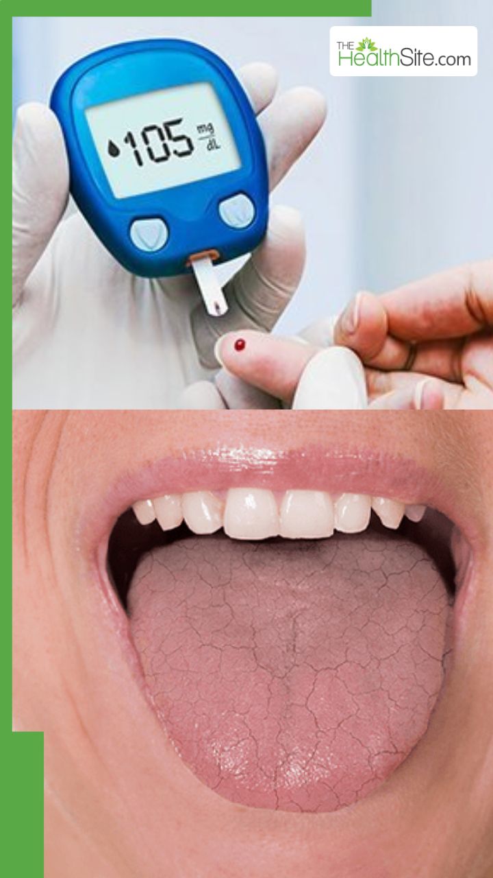 рдбрд╛рдпрдмрд┐рдЯреАрдЬ рдореЗрдВ рдмрд╛рд░-рдмрд╛рд░ рдореБрдВрд╣ рдХреНрдпреЛрдВ рд╕реВрдЦрддрд╛ рд╣реИ?