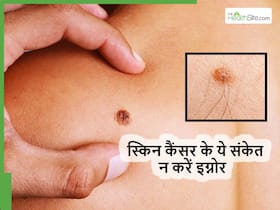 Skin Cancer का संकेत हो सकते हैं त्वचा में मामूली से दिखने वाले ये 5 लक्षण, ज्यादातर लोग कर देते हैं इग्नोर