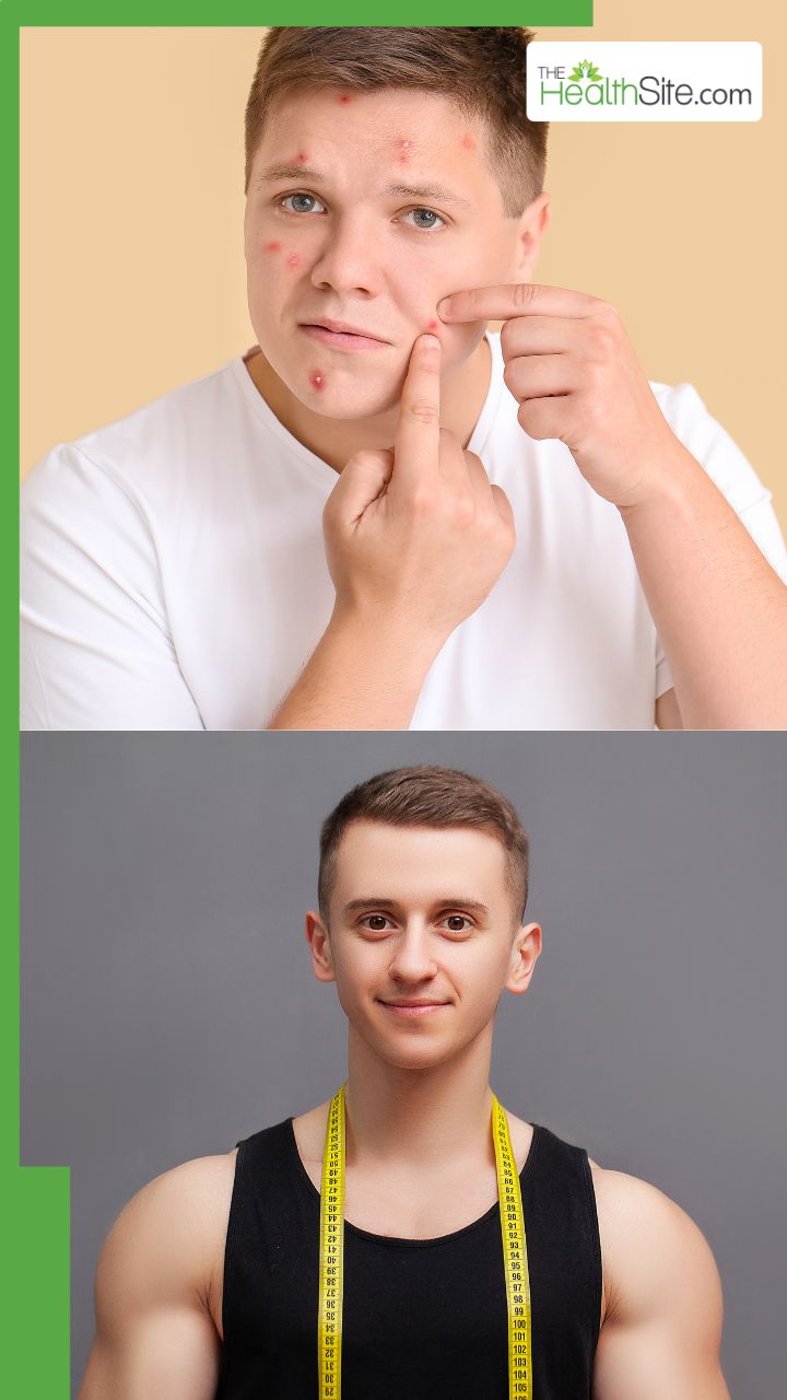 क्यों निकलते हैं लड़को के चहरे में दाने? कैसे करें इसे ठीक