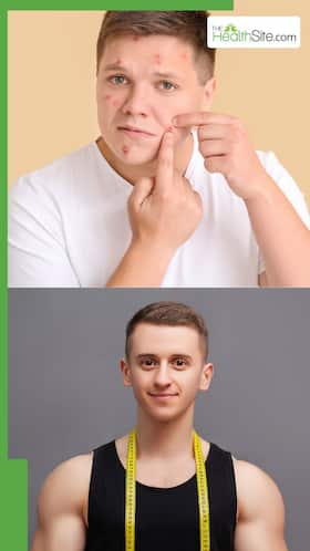 क्यों निकलते हैं लड़को के चहरे में दाने? कैसे करें इसे ठीक