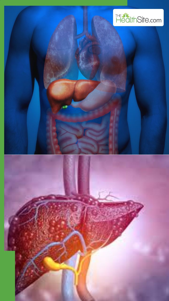 फैटी लिवर और सिरोसिस एक ही हैं या अलग है?