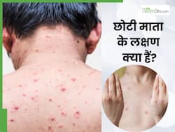 छोटी माता निकलने पर नजर आते हैं ये 5 लक्षण, जानें कितने दिनों में ठीक होती है यह समस्या