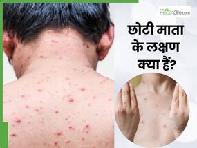छोटी माता निकलने पर नजर आते हैं ये 5 लक्षण, जानें कितने दिनों में ठीक होती है यह समस्या छोटी माता निकलने पर नजर आते हैं ये 5 लक्षण, जानें कितने दिनों में ठीक होती है यह समस्या