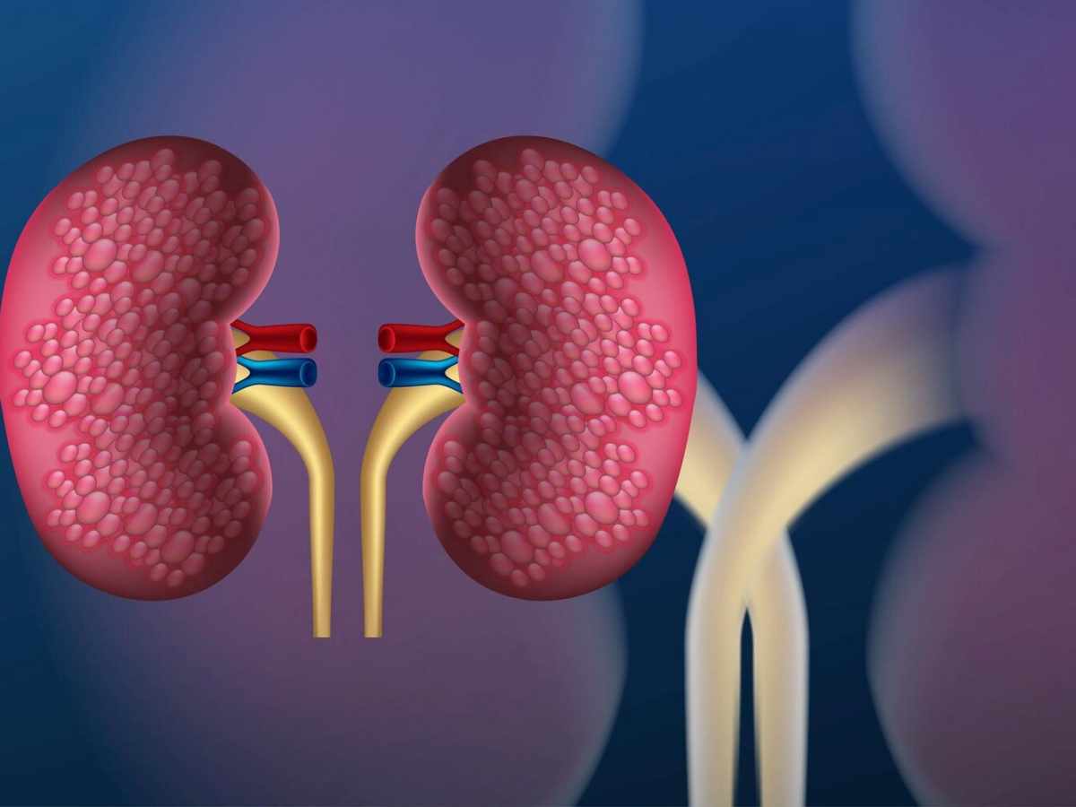 What is the treatment of ESKD?