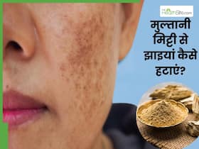 मुल्तानी मिट्टी से झाइयां कैसे हटाएं? जानें 3 तरीके, जिनसे दूर होंगे दाग-धब्बे और कालापन
