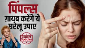 पिंपल्स को गायब करने के लिए फॉलो करें एक्सपर्ट का बताया ये देसी नुस्खा