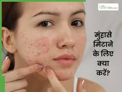 चेहरे से पिंपल्स हटाने के लिए क्या करें? जानें 4 घरेलू उपाय