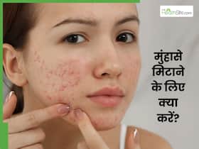 चेहरे से पिंपल्स हटाने के लिए क्या करें? जानें 4 घरेलू उपाय