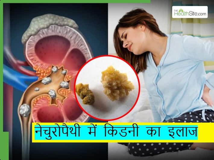 किडनी स्टोन्स या पथरी के लिए नेचुरोपैथी में हैं ये सस्ते इलाज, साइड-इफेक्ट्स का भी नहीं है चांस