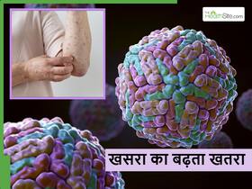 Measles के मरीज के साथ लापरवाही हो सकती है जानलेवा, जानें किन बातों का ध्यान रखना जरूरी Measles के मरीज के साथ लापरवाही हो सकती है जानलेवा, जानें किन बातों का ध्यान रखना जरूरी