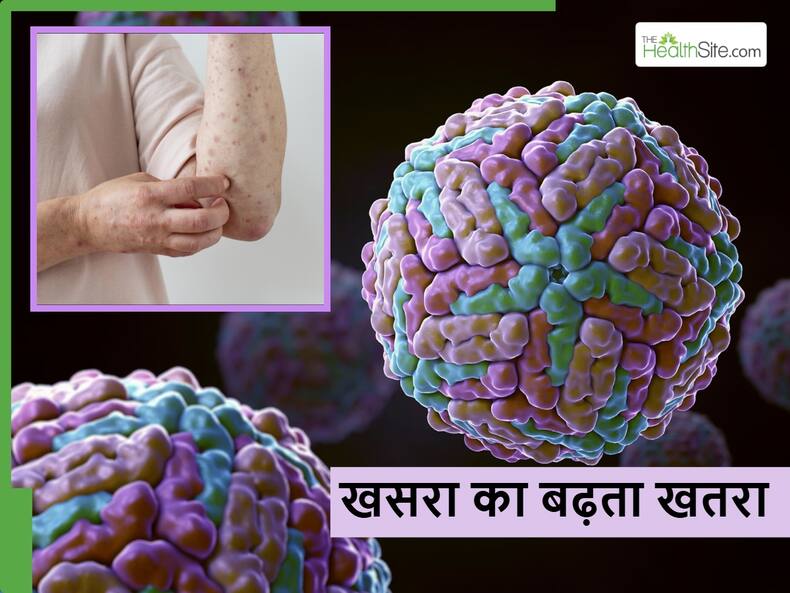 Measles के मरीज के साथ लापरवाही हो सकती है जानलेवा, जानें किन बातों का ध्यान रखना जरूरी