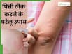 पित्ती उछलने पर क्या लगाना चाहिए? ये हैं जल्दी आराम देने वाले 5 देसी नुस्खे