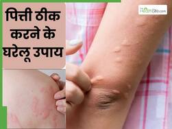 पित्ती उछलने पर क्या लगाना चाहिए? ये हैं जल्दी आराम देने वाले 5 देसी नुस्खे