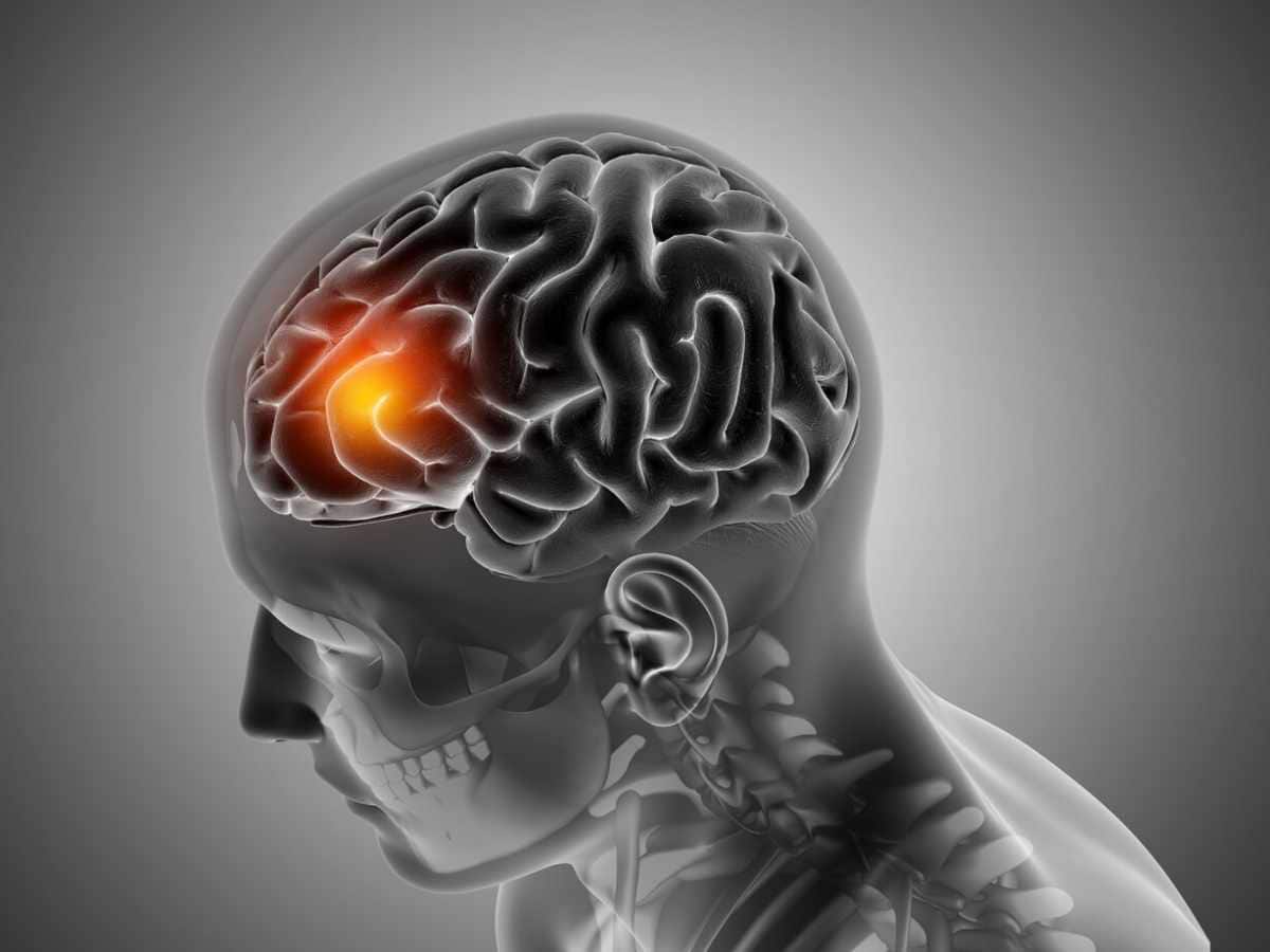 Regenerative medicine, Cell regeneration, Role Of Regenerative Medicine, Stem cell regeneration, Brain stroke, brain stroke symptoms, 