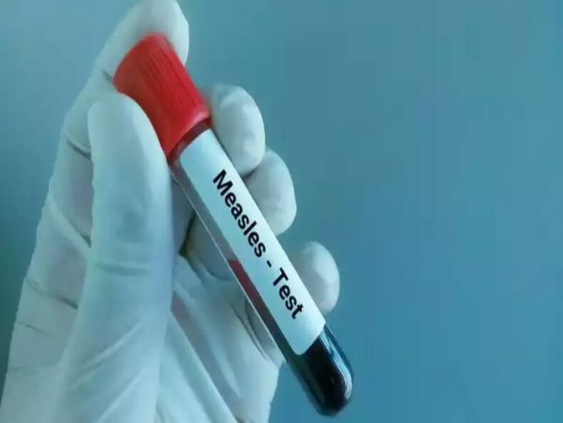 Measles के मरीज के साथ लापरवाही हो सकती है जानलेवा, जानें किन बातों का ध्यान रखना जरूरी